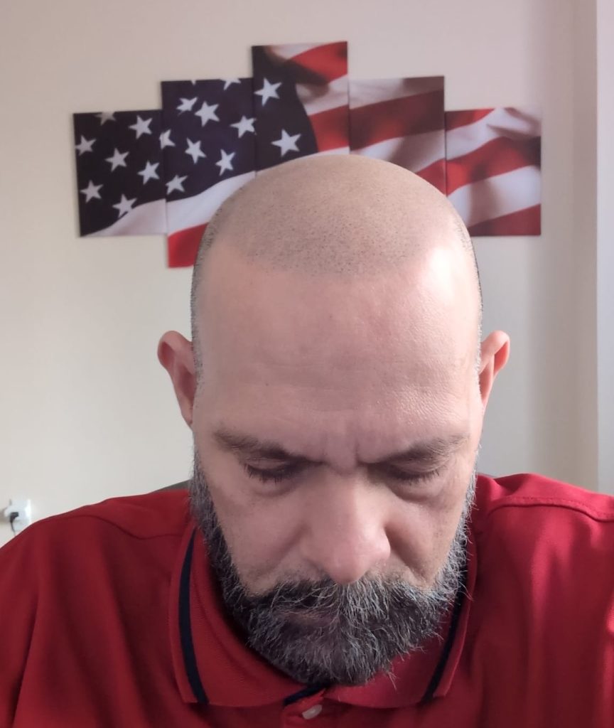 Hair Pigmentation in Fethiye Turkey