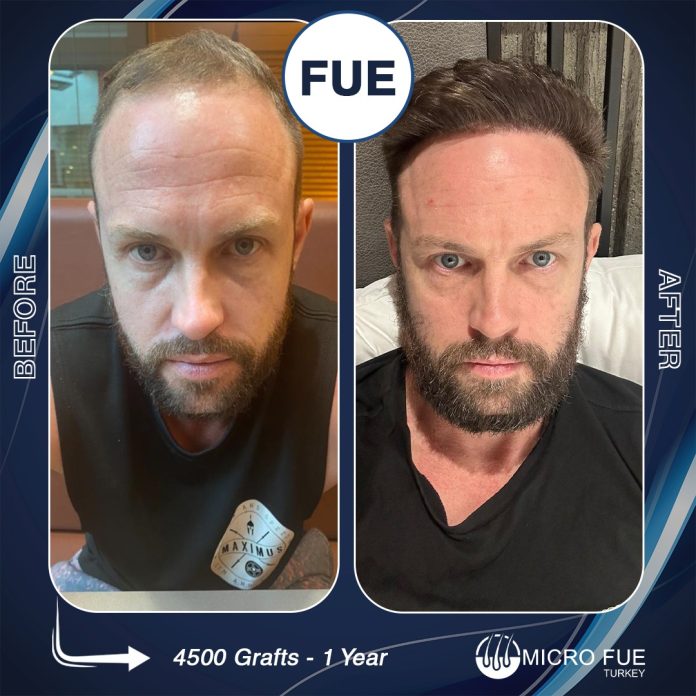 Antalya'da Saç Ekimi Randevusu Nasıl Alınır?