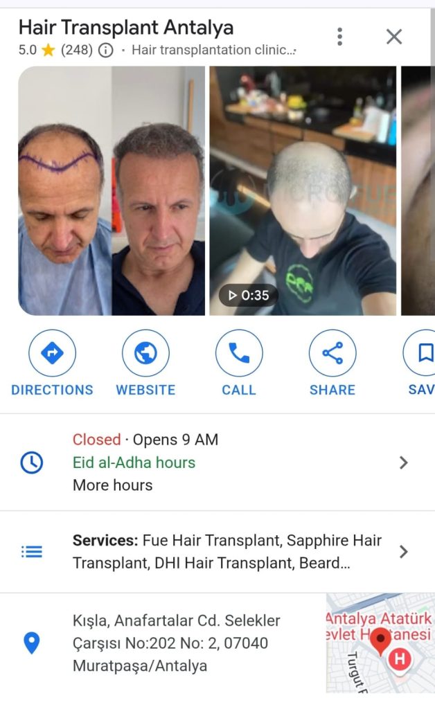 Best Hair Transplant in Antalya, Turkey