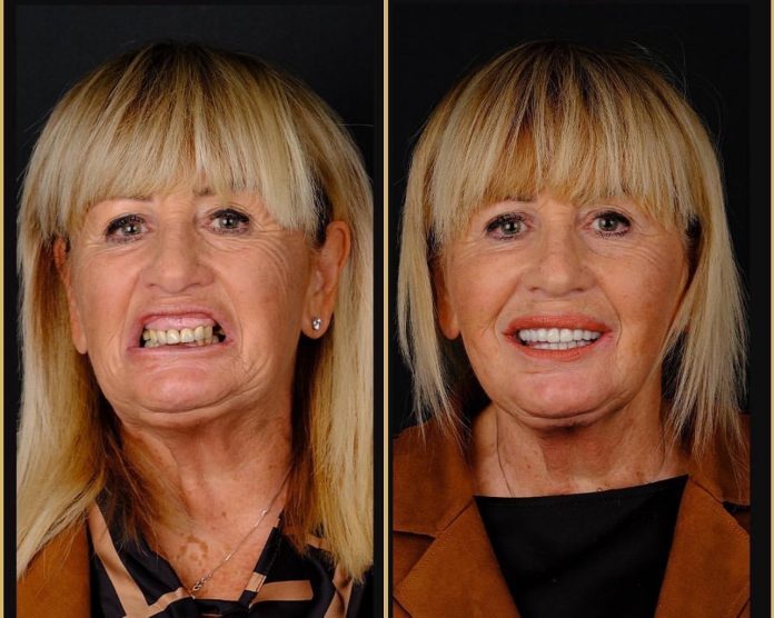 Step-by-Step Guide for Getting Dental Implants in Bodrum for International Patients