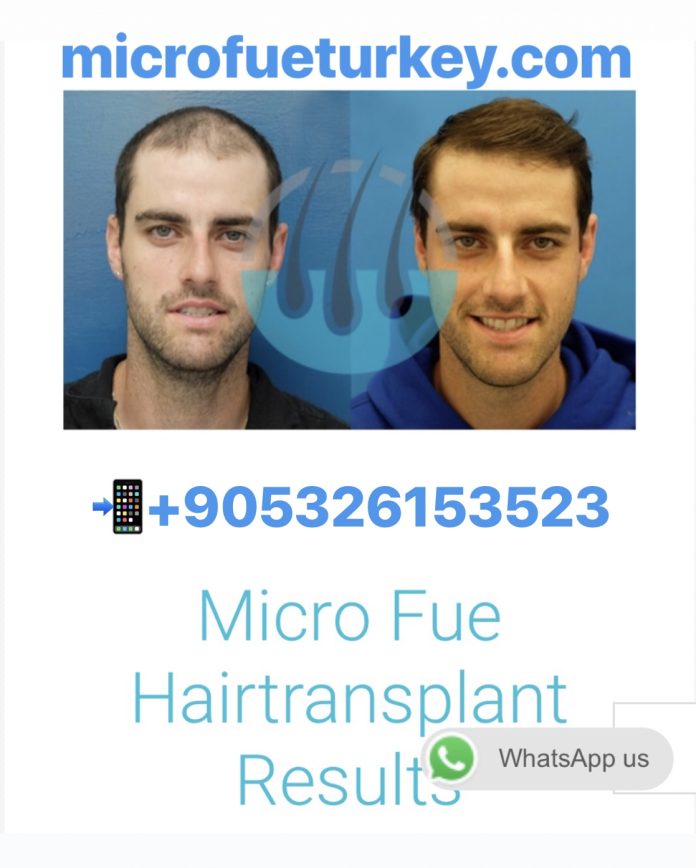 Hair Transplant İzmir